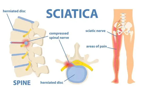 Sciatica